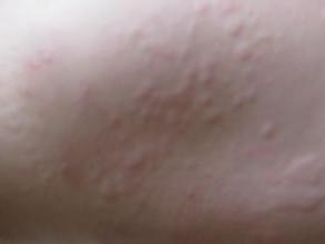 有多少人得荨麻疹