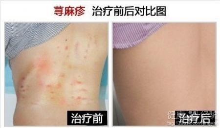 有多少人得荨麻疹