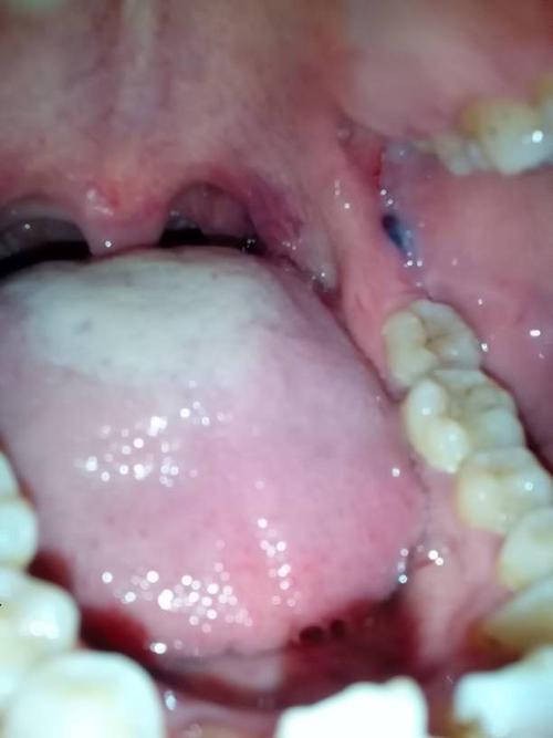 牙齿上有血块怎么办