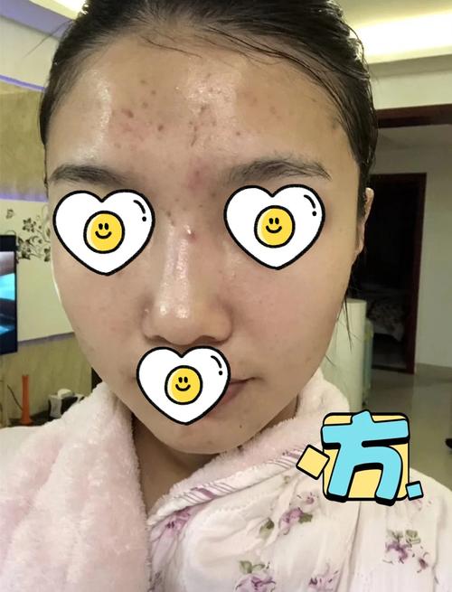 医院是怎么去痘印的