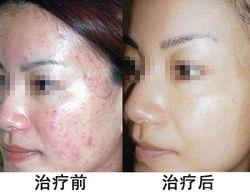 医院是怎么去痘印的